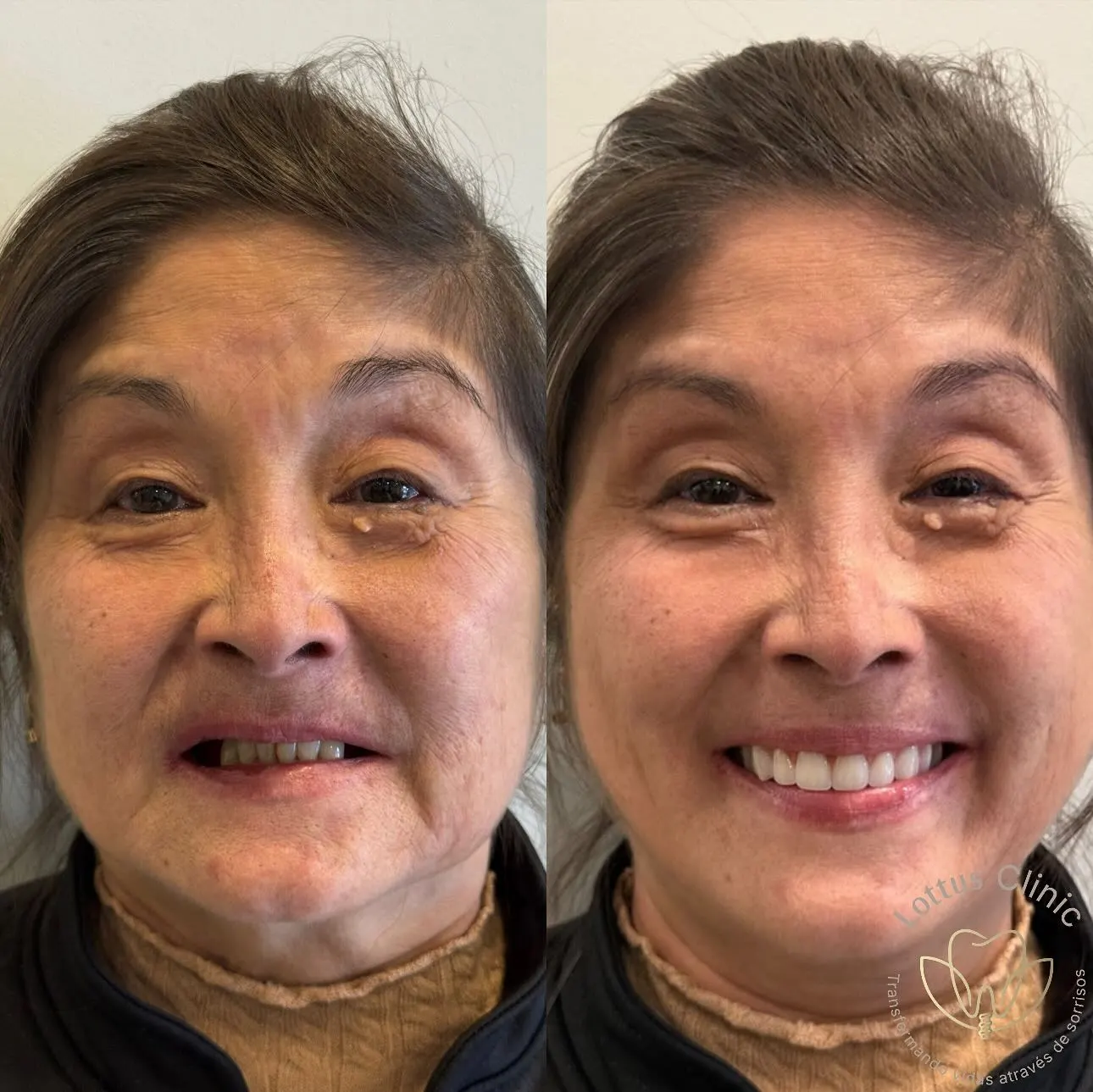 Caso de antes e depois de paciente da Lottus Clinic