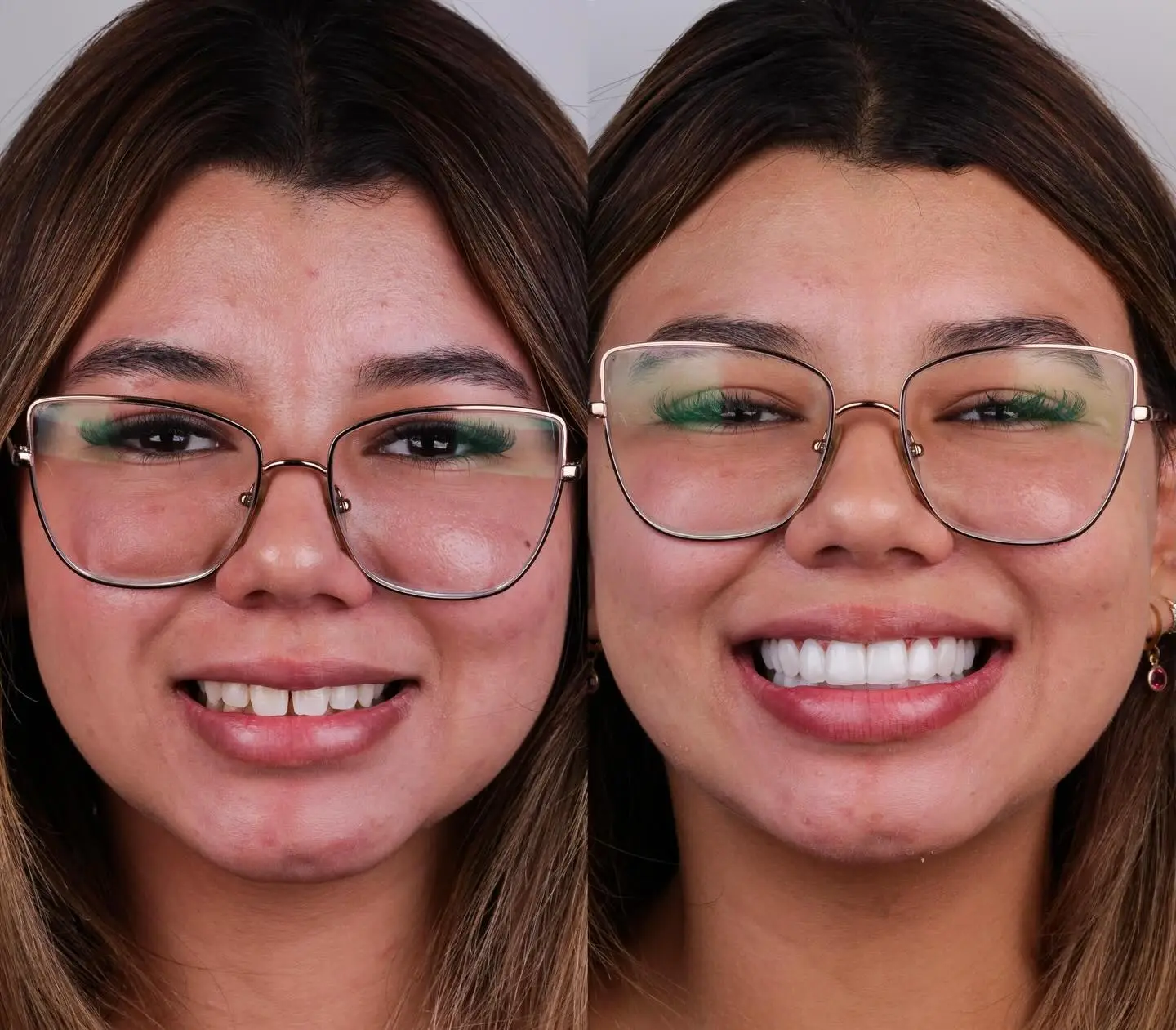 Caso de antes e depois de paciente da Lottus Clinic